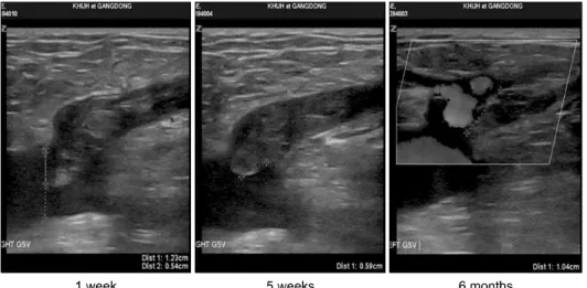 Fig. 1. The natural course of  endovenous heat-induced thrombosis The extension of thrombus into the  deep vein on one week was slightly  retracted on 5 weeks then, resolved  on 6 months