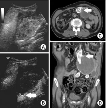 Fig. 1. Type I endoleak is shown in (A) conventional B-mode, (B)  CEUS, (C) and (D) CT angiography