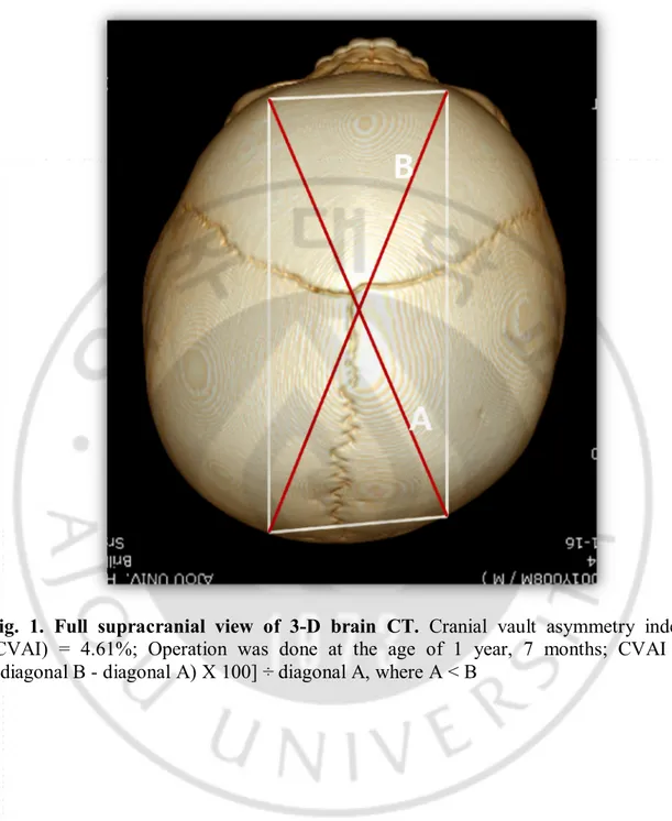 Fig.  1.  Full  supracranial  view  of  3-D  brain  CT.  Cranial  vault  asymmetry  index 
