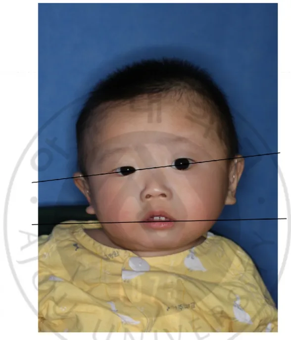 Fig.  2.  Standardized  anteroposterior  photograph  before  operation.  Inter-
