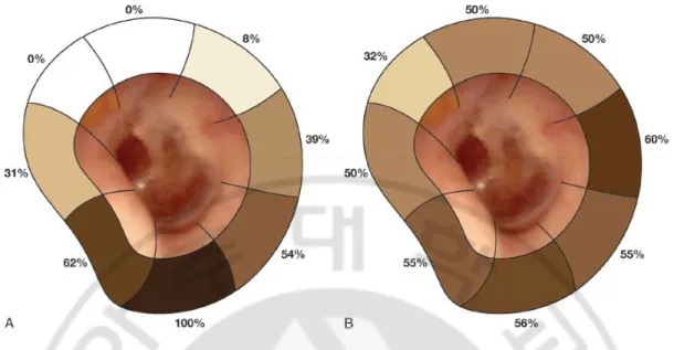 Fig. 1.Proportion of external auditory canal cholesteatoma (EACC)distribution(Dubach  and Häusler, 2008)