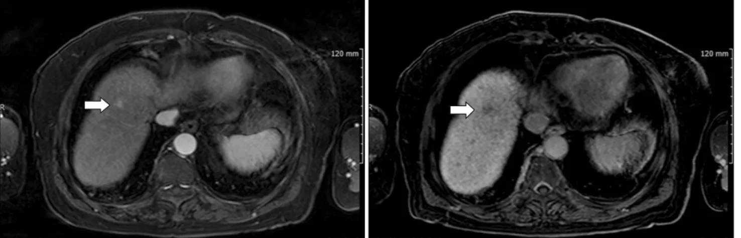 Fig. 1. MRI (primovist) showed a 1.5 cm sized HCC at segment 8 (white arrow).