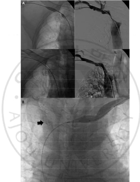 Fig. 9. 75-year old  male  with right brachiocephalic  AVF. Initial fistulography showed  near 