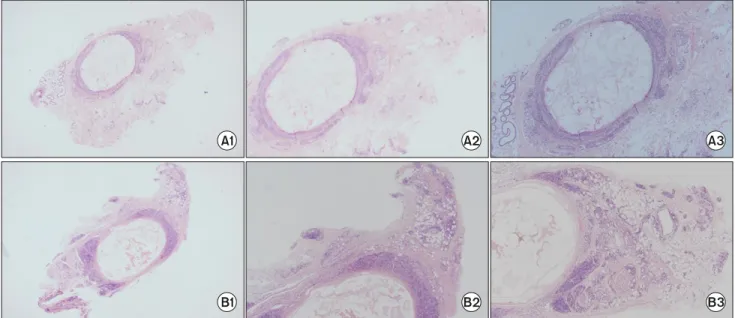 Fig. 4. Pathologic finding. The lymphocyte infiltration was seen mainly within the vein wall (A1, 2, 3) in the joint non-involvement group