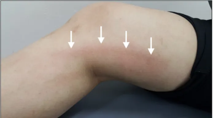 Fig. 5. Typical finding of the patient with phlebitis reaction after  cyanoacrylate closure