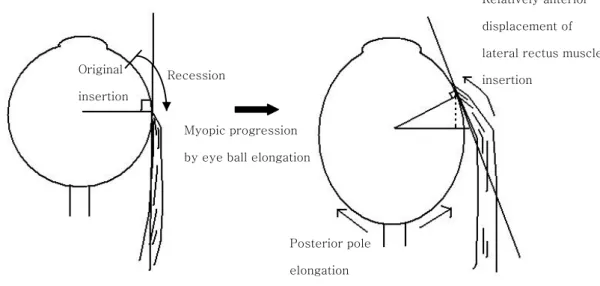 Figure  2.  Schematic  explanation  of  correlation  between  myopic  progression  and  postoperative exodrift