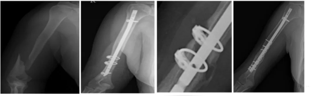 Fig.  3.  X-ray  of  Non-union  after  the  open  reduction  and  interlocking  IM  nailing  for  the  comminuted  humeral  shaft  fracture 