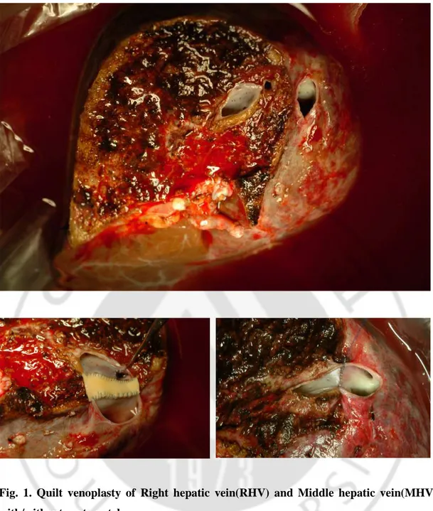 Fig.  1.  Quilt  venoplasty  of  Right  hepatic  vein(RHV)  and  Middle  hepatic  vein(MHV)  with/without aorta patch