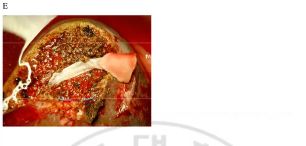Fig.  3.  In  right  lobe  graft  without  Middle  hepatic  vein(MHV),  Composite  MHV  reconstruction  and  formation  of  MHV  and  Right  hepatic  vein(RHV)  common  trunk