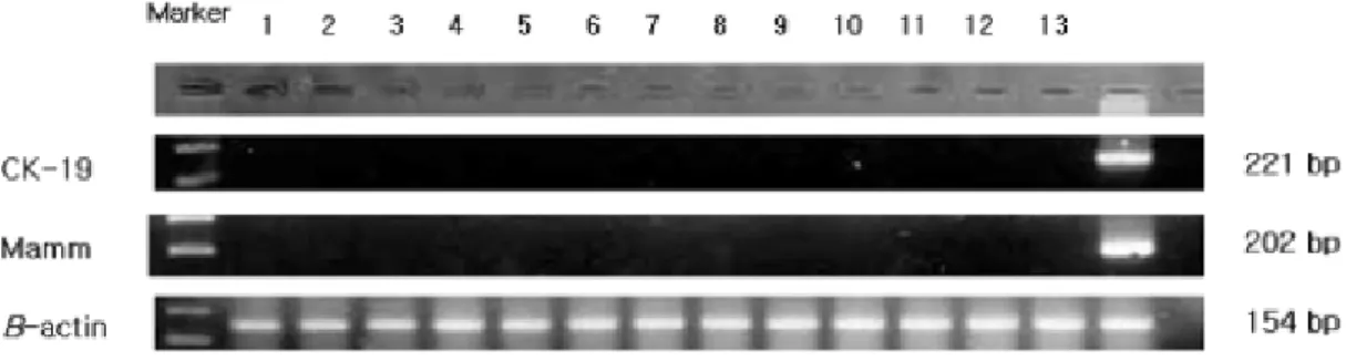 Fig.  3.  Nested  RT-PCR  for  beta  actin,  cytokeratin-19,  and  mammaglobin  in  control  group