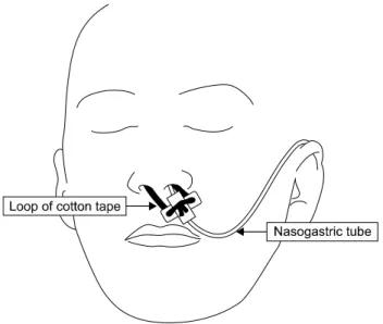 Fig.  1.  Nasogastric  tube  with  nasal  loop. 　본  글에서는  주로  뇌졸중  환자를  대상으로  시행하고  있는  경관식이의  종류,  시점의  선택과  시술  후  관리에  대해 서  알아보고자  하였다