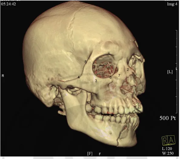 Fig. 2. Seven skeletal region were chosen for evaluation (1: orbital floor, 2: nasal bone, 3:  zygomaticomaxillary  suture,  4:  zygomatic  arch,  5:  zygomaticofrontal  suture,  6:  anterior  wall of the maxillary antrum, 7: maxillary process) 