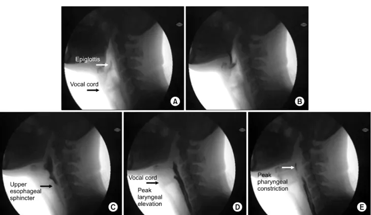 Fig.  1.  Swallowing  processes  of  a  normal  person.  A.  Initiation  of  pharyngeal  phase