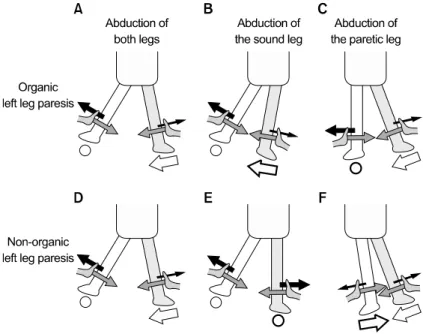 Fig. 4. Abductor sign 9) . 또한 같은 자세에서 검사자가 마비되지 않은 다리를 감쌌 던 손을 떼고 마비되지 않은 다리를 들어올리도록 지시했을 때 기질적 원인에 의한 마비 환자는 마비된 다리가 바닥면을 누르는 힘이 검사자의 손에 상대적으로 약하게 느껴지나 비기질적 원인에 의한 마비 환자는 마비된 다리를 바닥면으로 누르는 힘이 검사자의 손에 상대적으로 강하게 느껴지게 되며  이런  경우  역시  Hoover  test  양성으로  판단한다