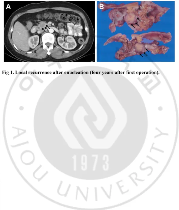 Fig 1. Local recurrence after enucleation (four years after first operation).   