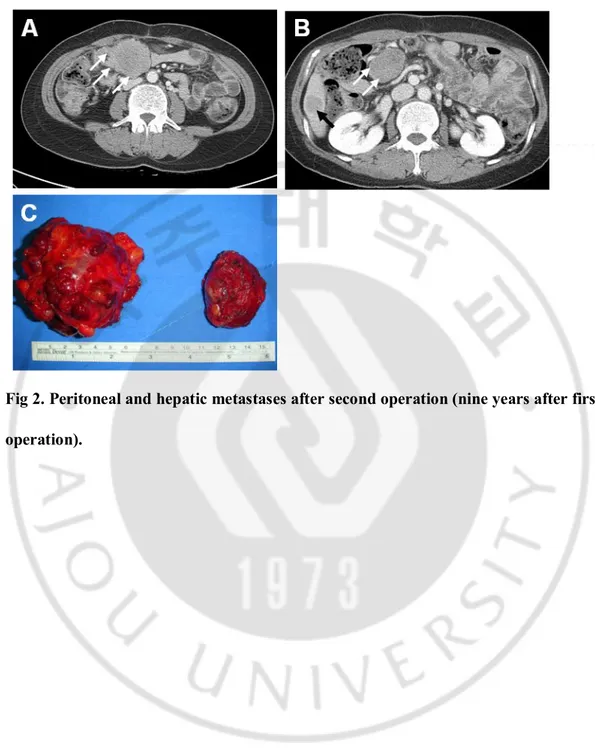 Fig 2. Peritoneal and hepatic metastases after second operation (nine years after first  operation)