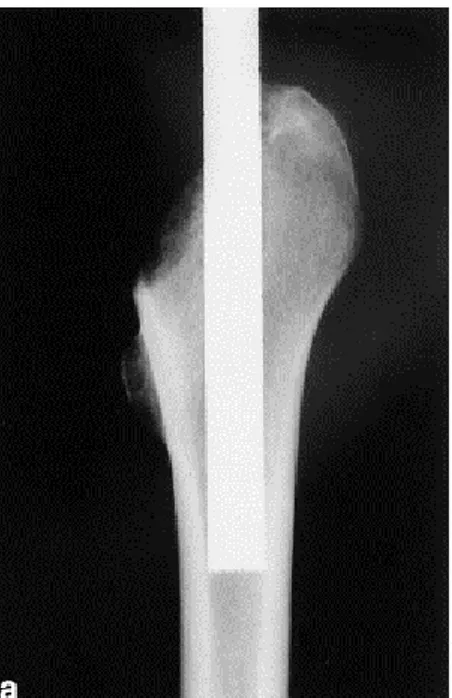 Fig.  1.  A  10  mm  tube  saw  used  to  biopsy  the  intertrochanteric  region  of  the  proximal femur