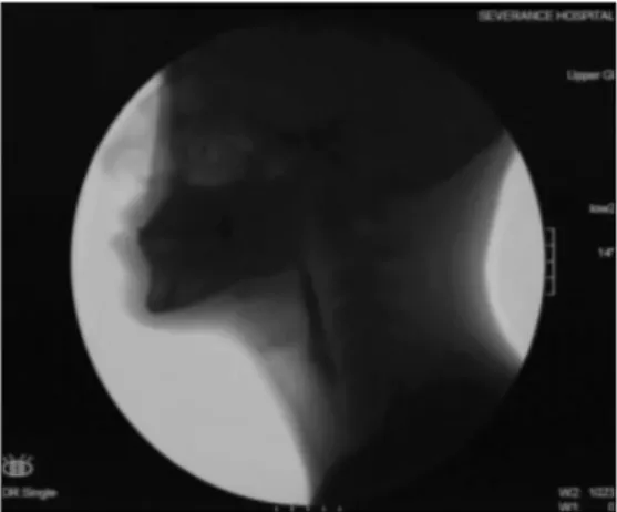 Fig.  1.  Normal  finding  of  videofluroscopic  swallowing  study.