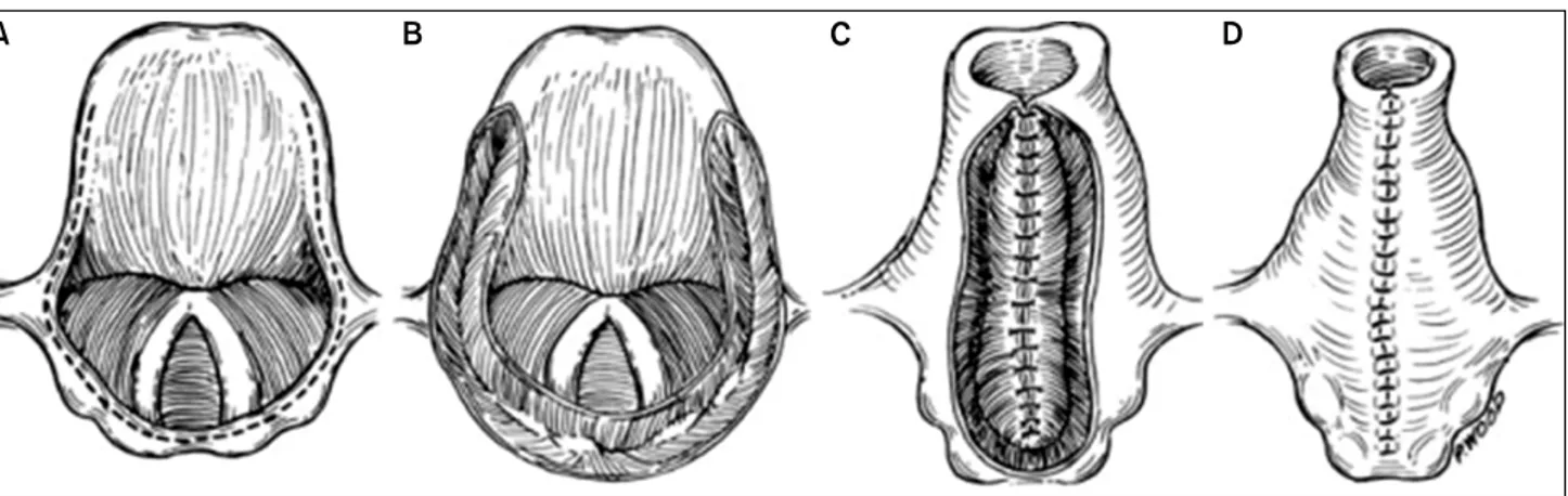 Fig.  8.  Narrow-field  laryngectomy.  A.  Outline  of  larynx  removal;  the  hyoid  is  preserved