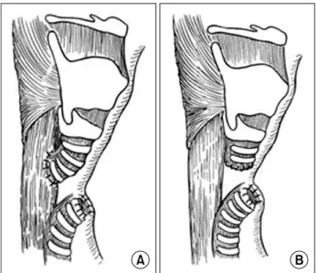 Fig.  9.  Subperichondrial  cricoidectomy.  A.  Cricoid  incision.  B.  The  cricoid  cartilage  is  opened