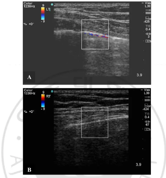 Fig. 1. Color Doppler sign in ultrasonography in normal patient (A), and absent color  Doppler sign in ultrasonography in patient with pneumothorax (B)