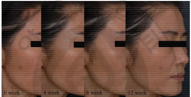 Fig. 1. Clinical photographs from 0 week to 12 week after topical TA application. The 