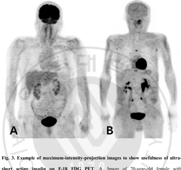 Fig.  3.  Example  of  maximum-intensity-projection  images  to  show  usefulness  of  ultra- ultra-short  acting  insulin  on  F-18  FDG  PET