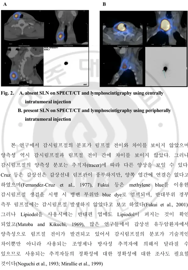 Fig. 2.    A. absent SLN on SPECT/CT and lymphoscintigraphy using centrally    intratumoral injection 