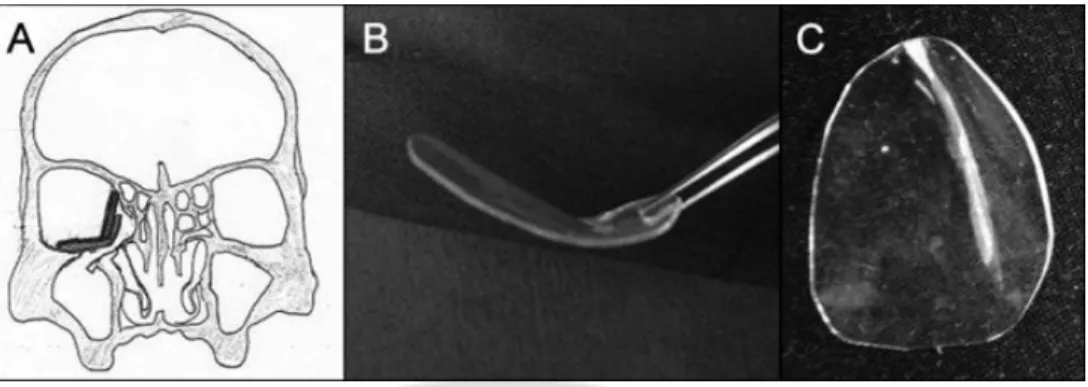 Fig. 1. Overlapping method for repairing of floor and medial wall fractures with loss  of  bony  strut
