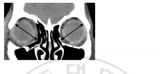 Fig. 2. The maximal diagonal lengths of the orbit in the operated and non-operated eye