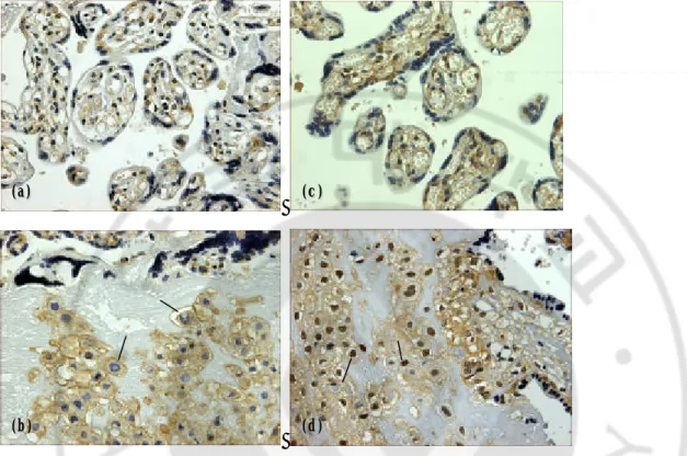 Fig. 1. Immunohistochemical staining of NF -kB (p50). (a) &amp; (b) normal placenta; (c) &amp; (d)  preeclamptic placenta