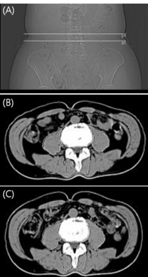 Figure 1. View of computer tomography of L4 upper and  lower plate (A), before exercise (B), after exercise (C).