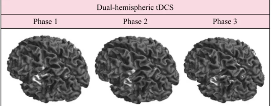 Figure 1. Cortical activation map of the functional MRI data during bipolar transcranial direct current  stimulation on bilateral hemispheres (anodal electrode on the left SM1 and cathodal electrode on the right  SM1 or on the supraorbital area).