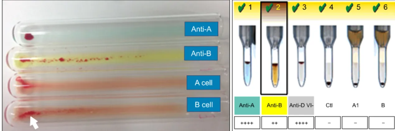 Fig.  1.  The  results  of  14-ABO-2  sample  with  discrepant  result  between  cell  typing  and  serum  typing  by  tube  technique  (left)  and  column  agglutination  technique  (right)