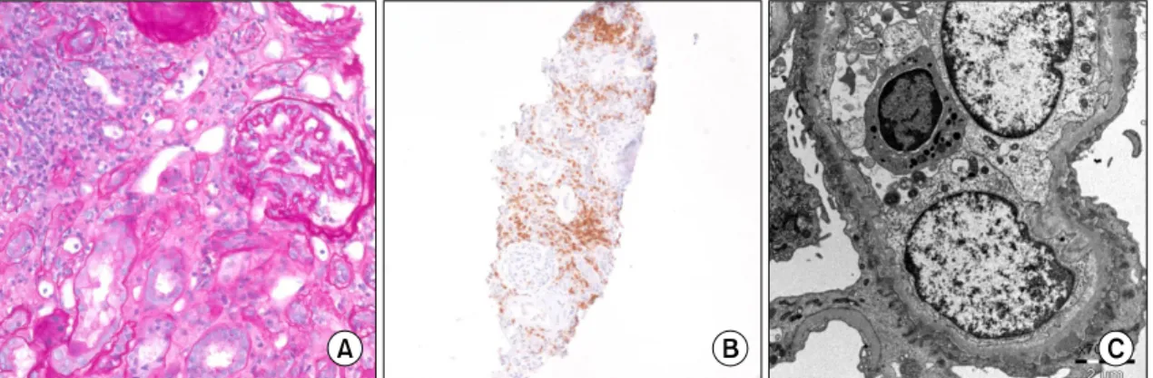 Fig.  2.  (A)  Light  microscopy  shows  normal  appearance  of  glomeruli  without  thickened  basement  membrane  and  tubules  reveal  mild  atrophy  and  acute  damage  accompanied  by  moderate  interstitial  fibrosis  and  moderate  mononuclear  infi