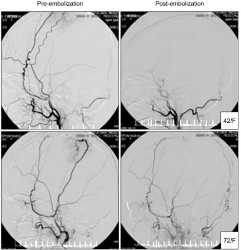 Fig.  2.  Examples  of  com- com-parison  of  vasculature   be-tween  preoperative   emboli-zation  and  postemboliemboli-zation  state  in  meningioma  patients.