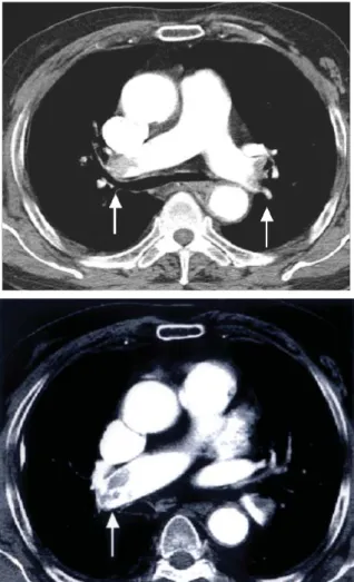 Fig. 2. Contrast-enhanced CT scans show thrombi in the main pulmonary artery and the interlobar artery (arrows).