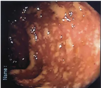 Fig. 1. A sigmoidoscopic finding in the patient of Case 1. Multiple yellowish plaques were noted from the rectum to the sigmoid colon.