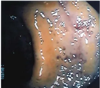 Fig. 4. A sigmoidoscopic finding in the patient of Case 2. Multiple yellowish plaques and edematous mucosa were noted on the rectum to the sigmoid colon.