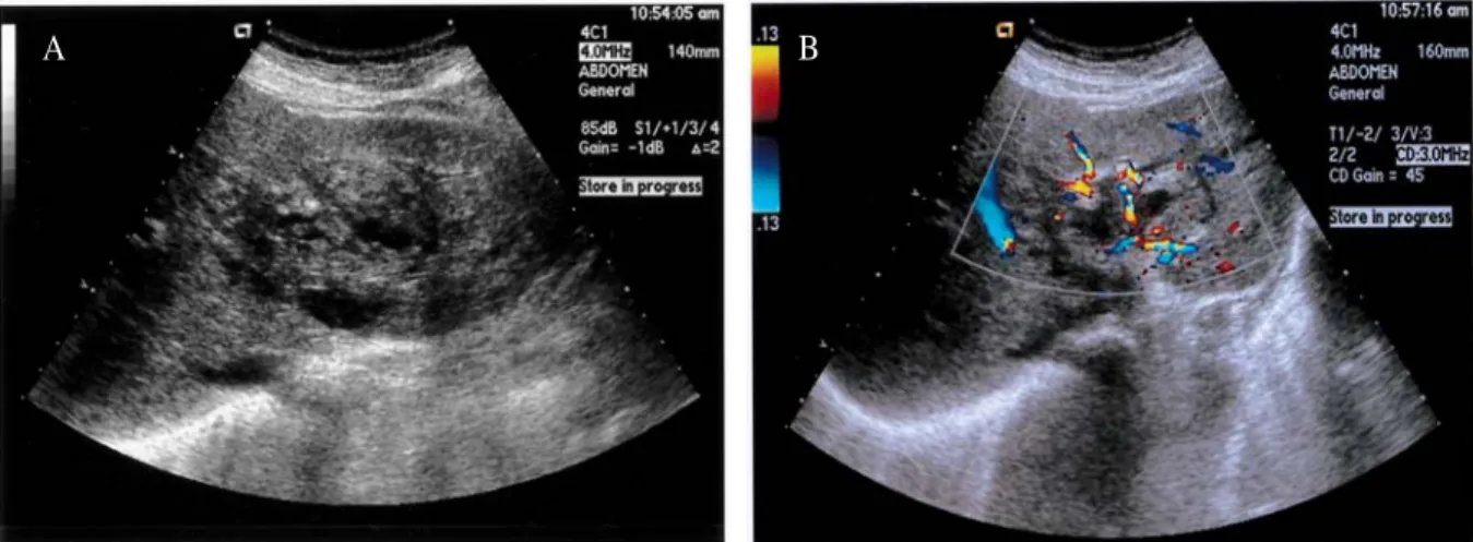 Fig. 1. Gray scale and color Doppler ultrasonogram of hepatic angiosarcoma. (A) Transverse US scan of the liver shows a large heterogeneous mass with multiple hypoechoic lesions in the left lobe