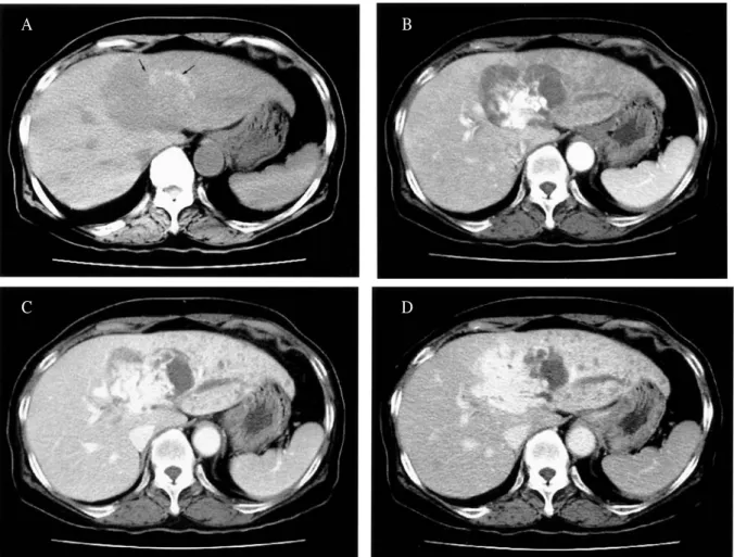 Fig. 2. Computed tomographic findings of hepatic angiosarcoma. (A) Precontrast CT scan shows a large hypoattenuating mass with marginal hyperattenuating lesions (arrows) suggesting focal areas of hemorrhage.