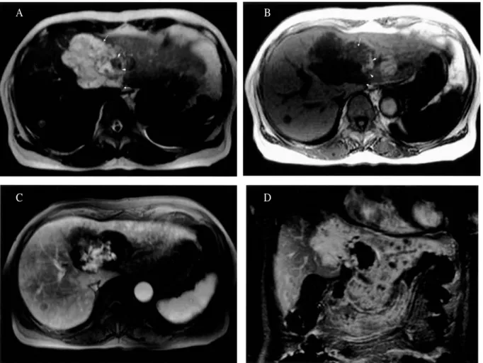 Fig. 3. Magnetic resonance findings of hepatic angiosarcoma. (A) T2-weighted MR image shows very hyperintense components (arrows) in three quarters and heterogeneous hypointense components (arrowheads) in one quarter of this mass