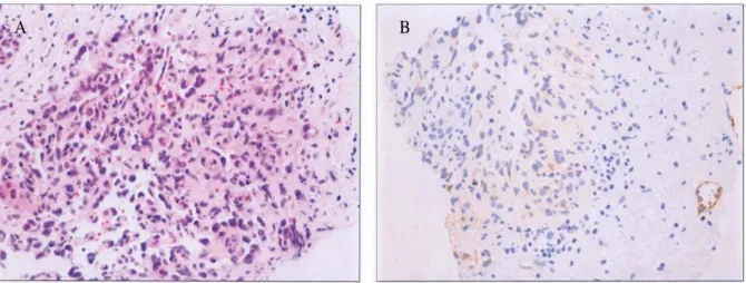 Fig. 4. The histopathologic and immunohistochemical findings of hepatic angiosarcoma. (A) Microscopic finding shows characteristic histologic pattern, which is a scaffold-like or tectorial growth of atypical cells between liver cell plates (H&amp;E,  400)