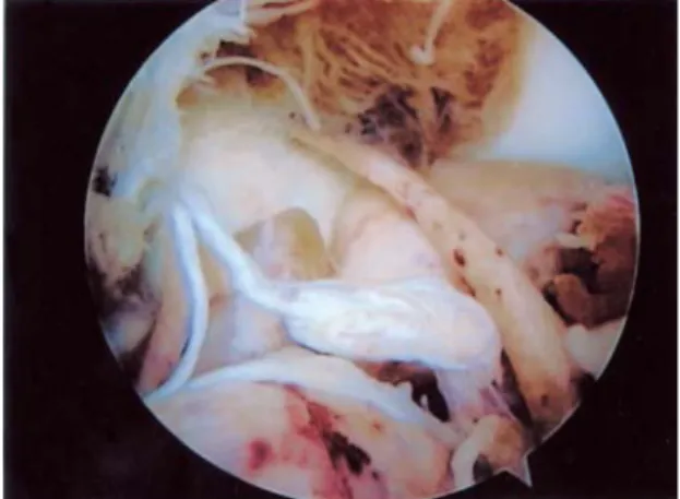 Fig. 2. Knee MRI (T2WI) shows dark signal intensity in synovial thickening area due to hemosiderin deposition.