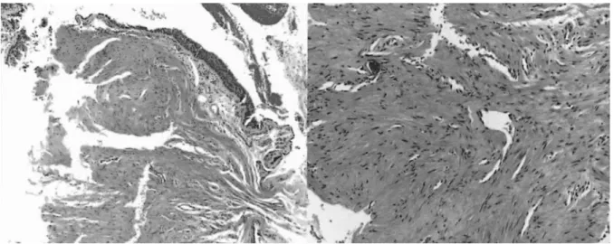 Fig. 2. Bronchoscopy shows hyperemic irregular surfaced polypoid exophytic mass in left main bronchus, partially obstructing lumen.