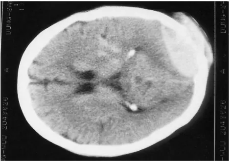 Fig. 1. Brain CT shows an extraaxial mass with bony destruction in left occipital area.