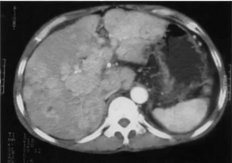 Fig. 2. Contrast-enhanced abdominal CT scan shows multiple enhancing hepatic masses in both lobes.