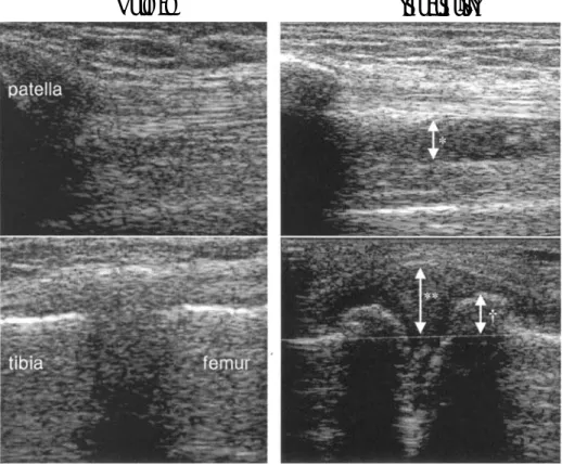 Fig. 1. Knee ultrasonographic findings of a normal and an osteoarthritis patient.         