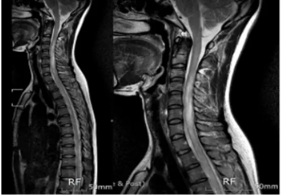 Fig.  1.  C-T  spine  MRI  after  5th  recurrence.