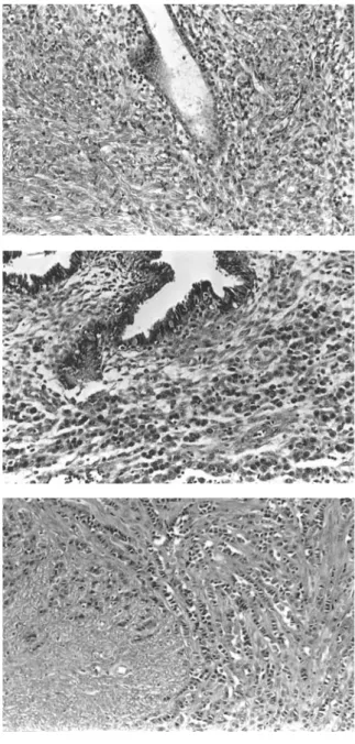 Fig. 1. Diffusely  infiltrating  strands  of  round  to  ovoid tumor  cells  in  the  indian-file pattern  in  the whole  uterus,  including  uterine  cervix  (A), endo-  and  myometrium  (B)  and  leiomyoma itself (C) (H&amp;E stain, x 100).
